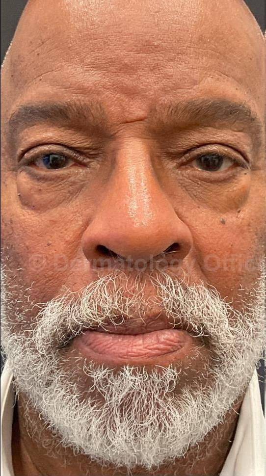 Platelet-Rich Plasma Before and After Case 2 Before