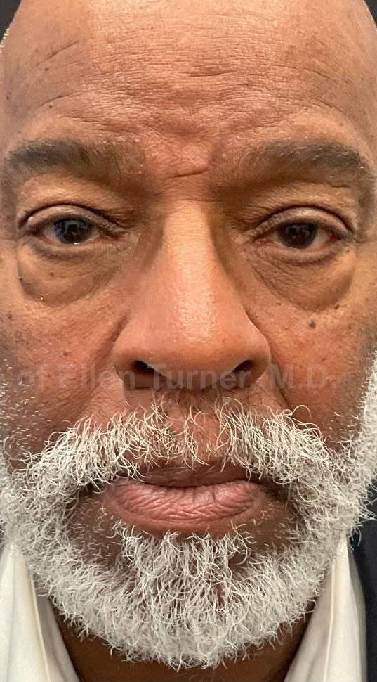 Platelet-Rich Plasma Before and After Case 2 After