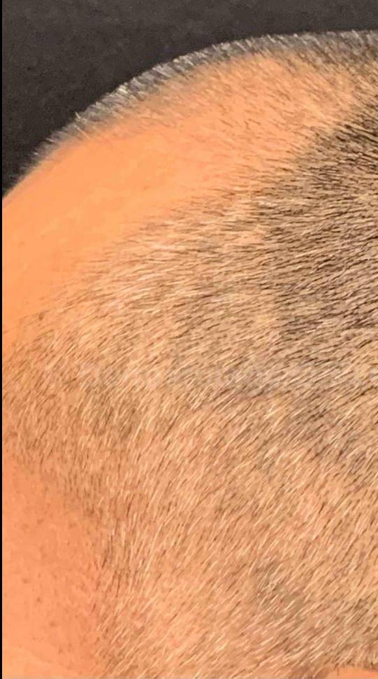 Exosomes Case- 4 Before