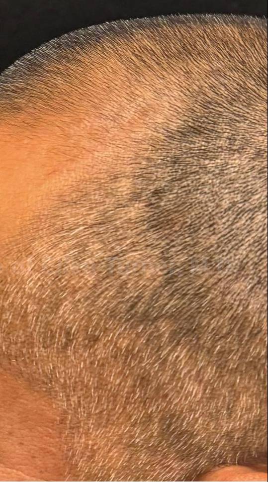 Exosomes Case- 4 After