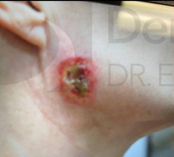 Exosomes Before and After Case 2 Before