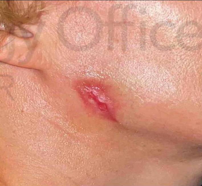 Exosomes Before and After Case 2 After