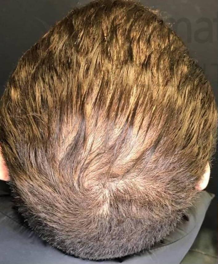 Platelet-Rich Plasma (3 Treatment) Case-4 Before