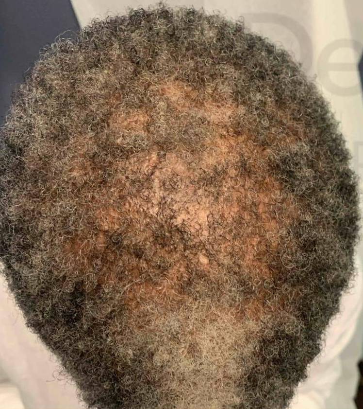 Hair Restoration Before and After Case 5 Before