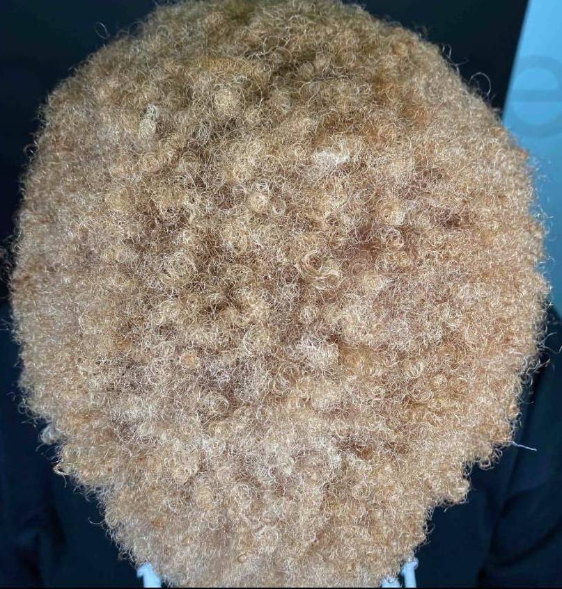 Hair Restoration Before and After Case 5 After