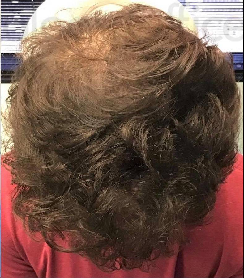 Hair Restoration (2 Treatment Exosomes) Case-8 After