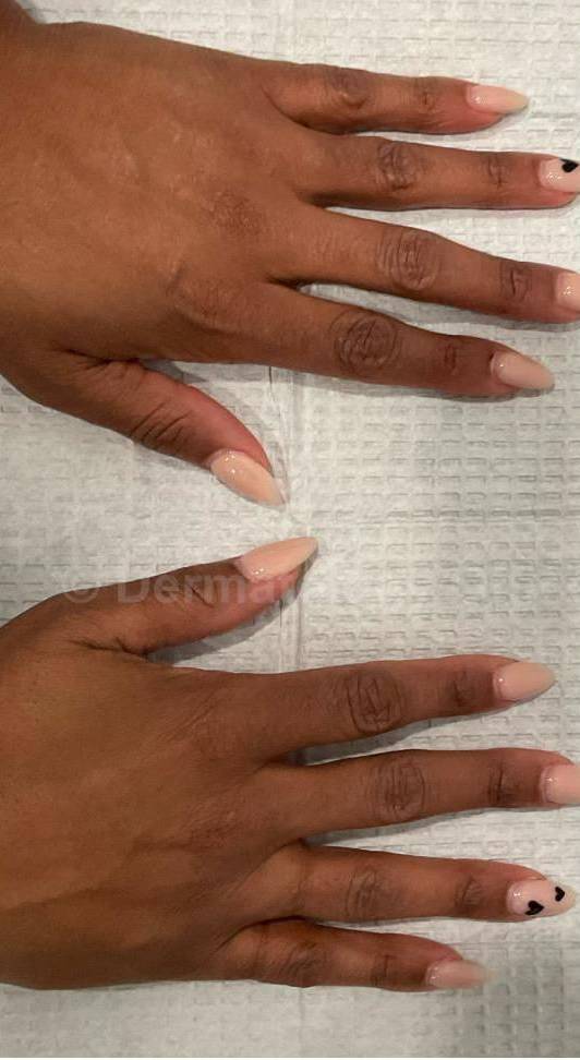 Fillers Before and After Case 1 Before