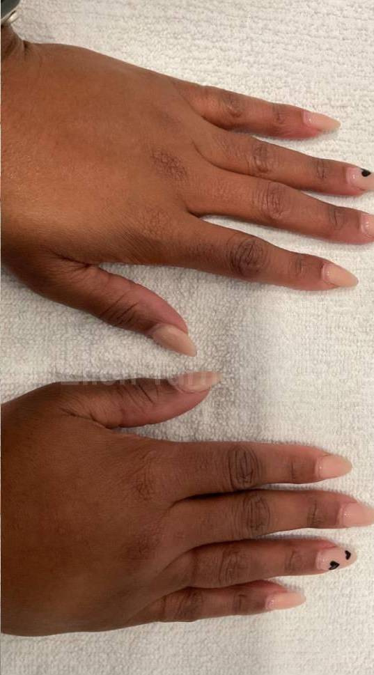 Fillers Before and After Case 1 After