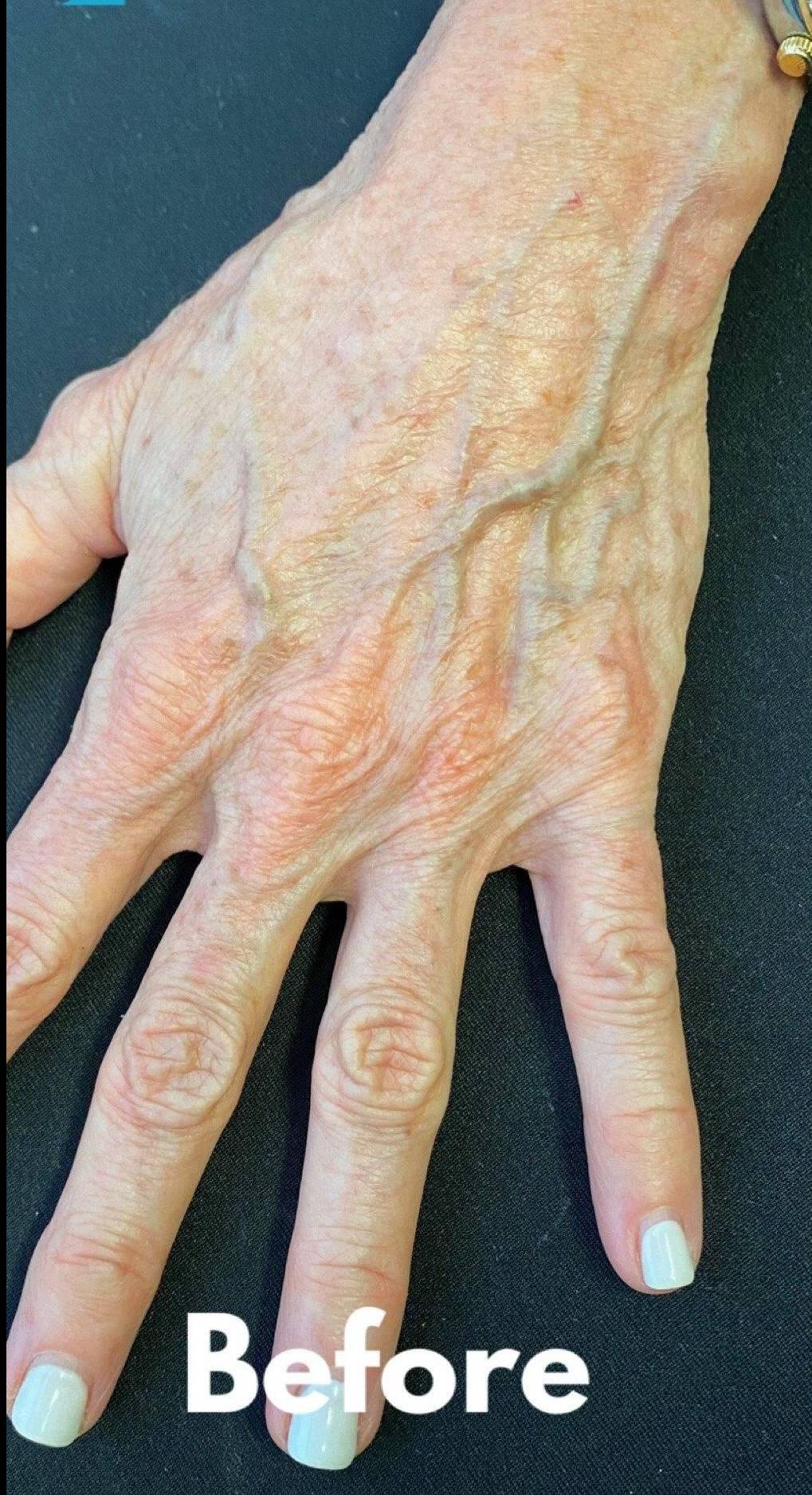 Radiesse Hands (2 Syringes) Before and After Case 4 Before