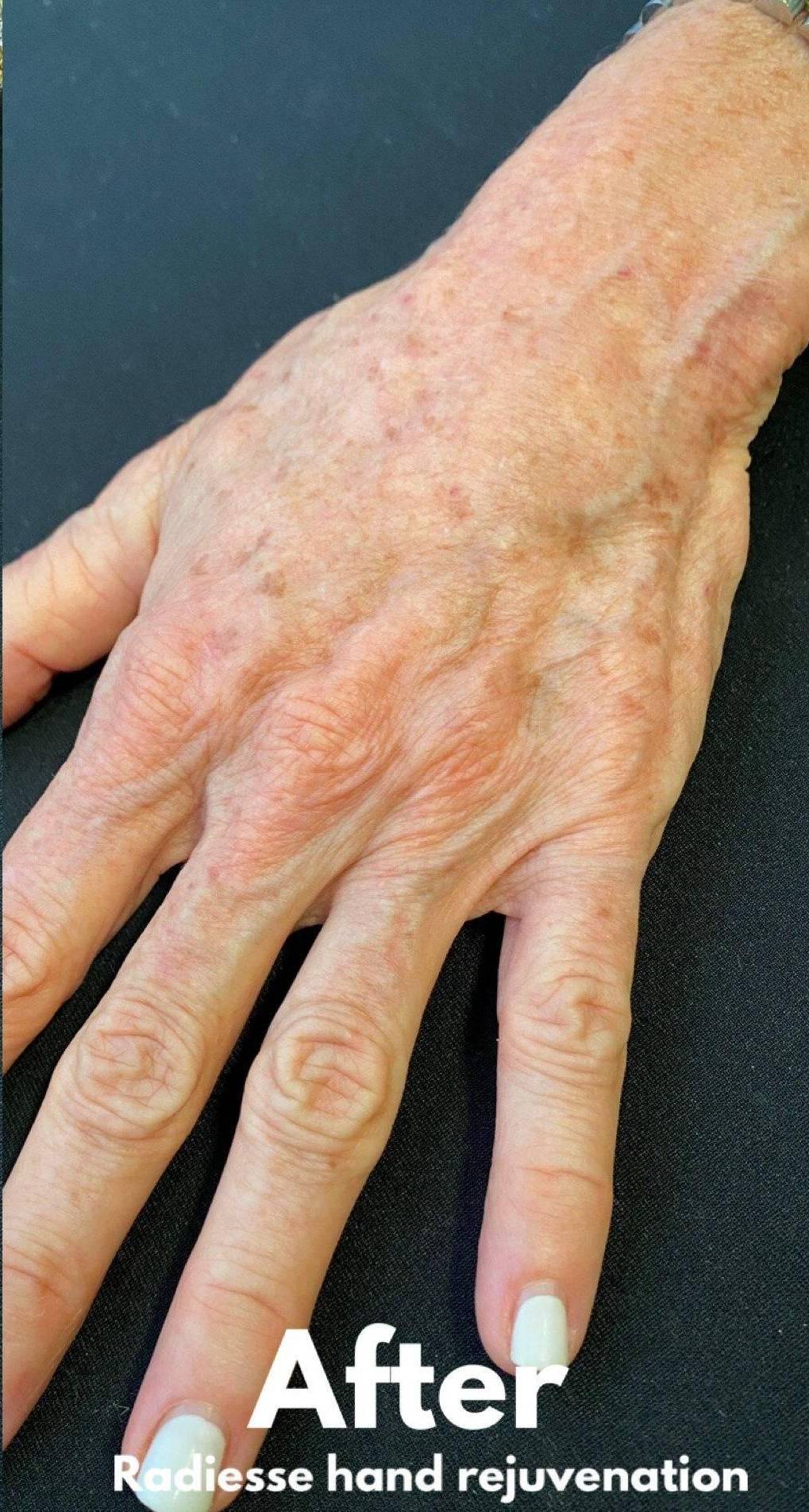 Radiesse Hands (2 Syringes) Before and After Case 4 After