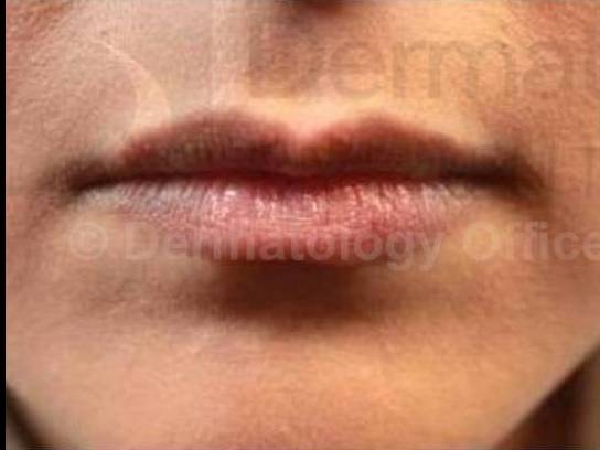 Juvederm  Case-2 Before