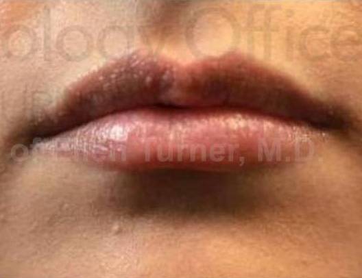 Juvederm  Case-2 After