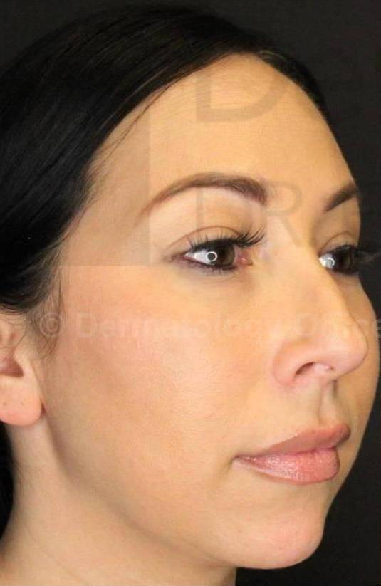 Juvederm  Case-1 Before