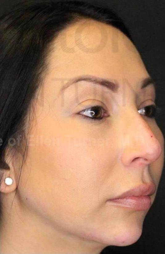 Juvederm  Case-1 After