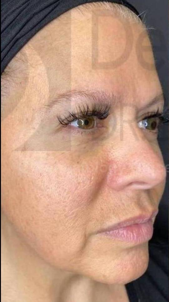 Juvederm  Case-4 Before