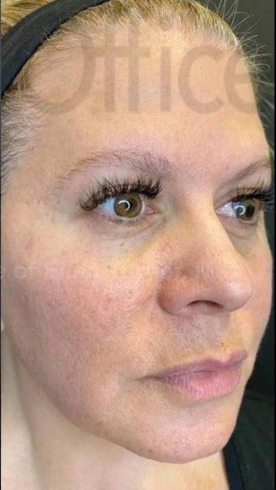 Juvederm  Case-4 After