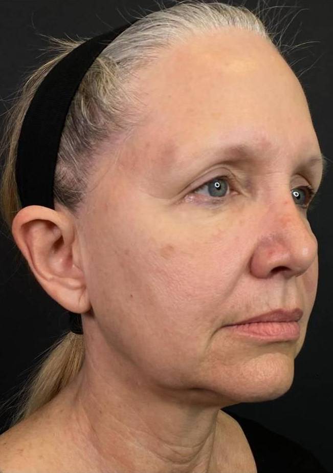 Juvederm  Case-7 Before