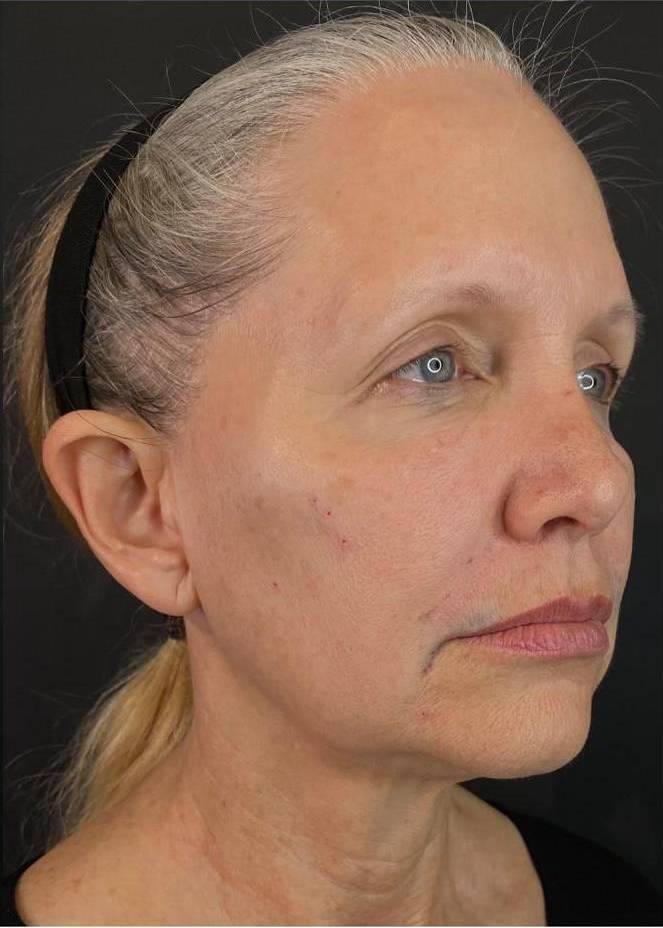Juvederm  Case-7 After
