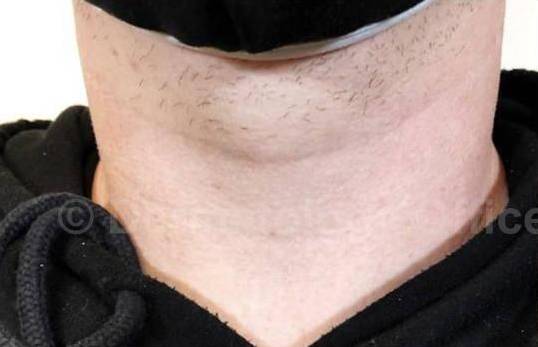 Juvederm  Case-10 Before