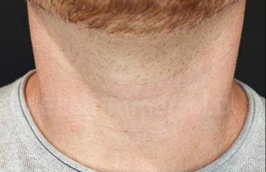 Juvederm  Case-10 After