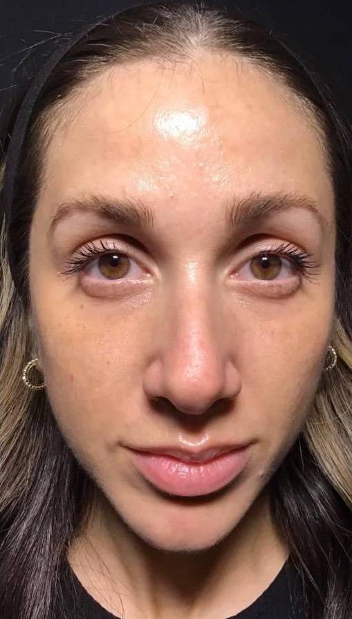 Juvederm  Case-16 Before