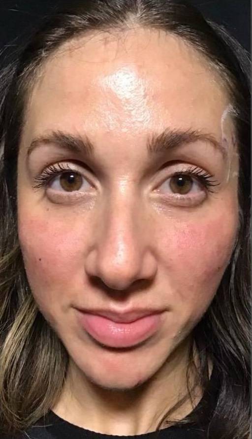 Juvederm  Case-16 After