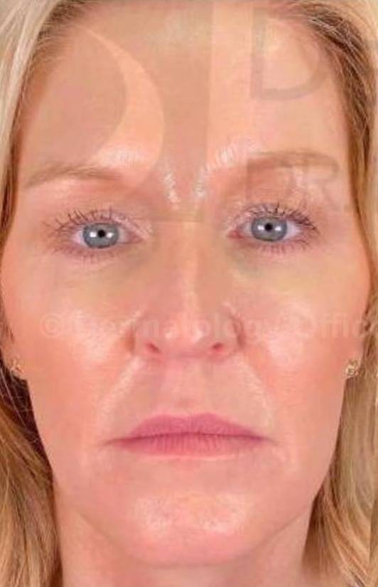 Juvederm  Case-17 Before