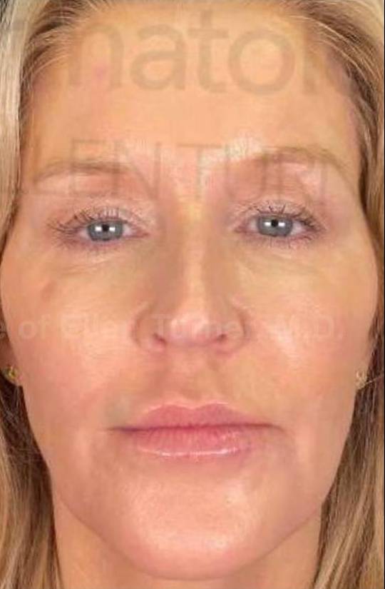 Juvederm  Case-17 After
