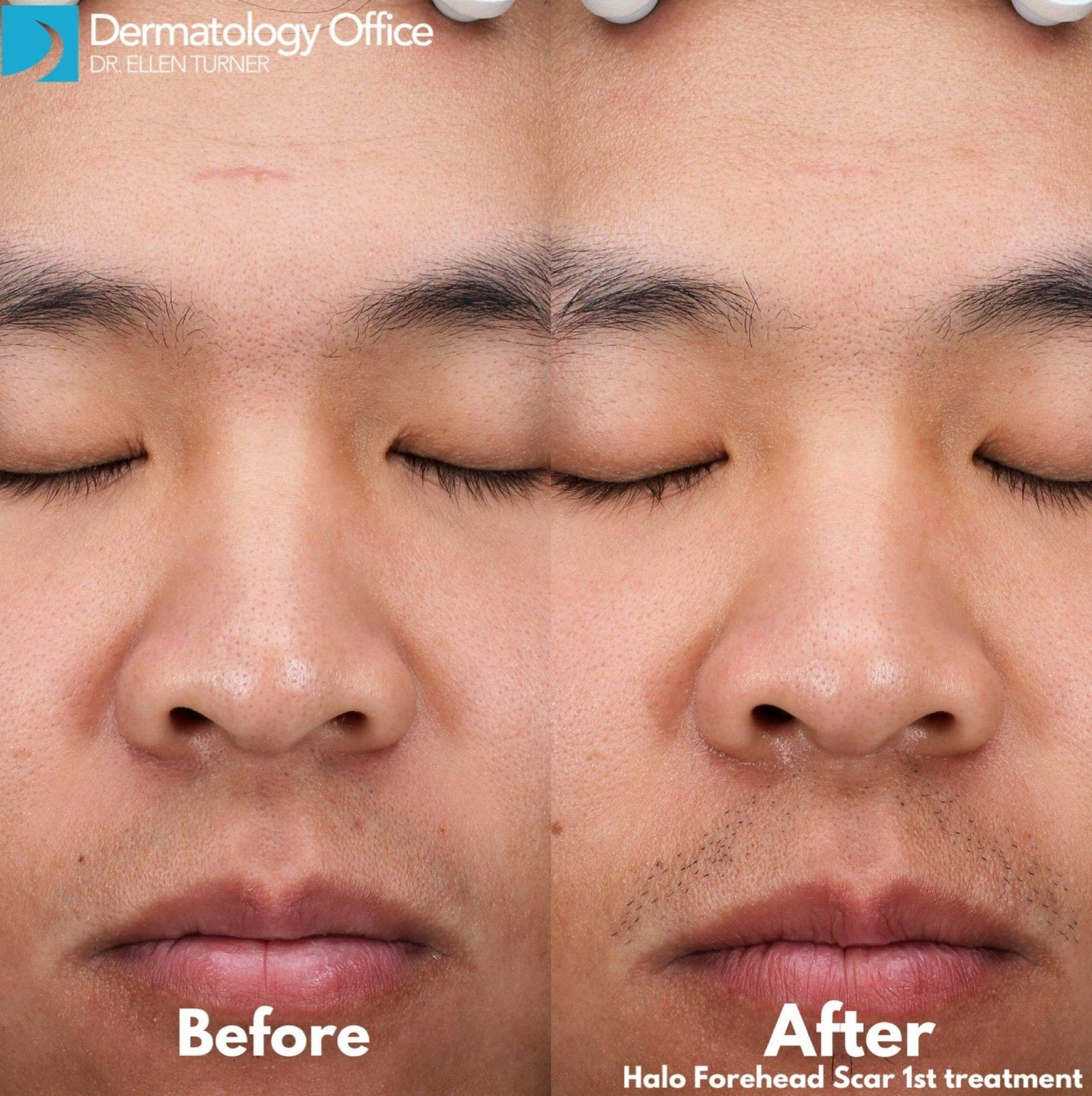 Halo Before and After Case 6 