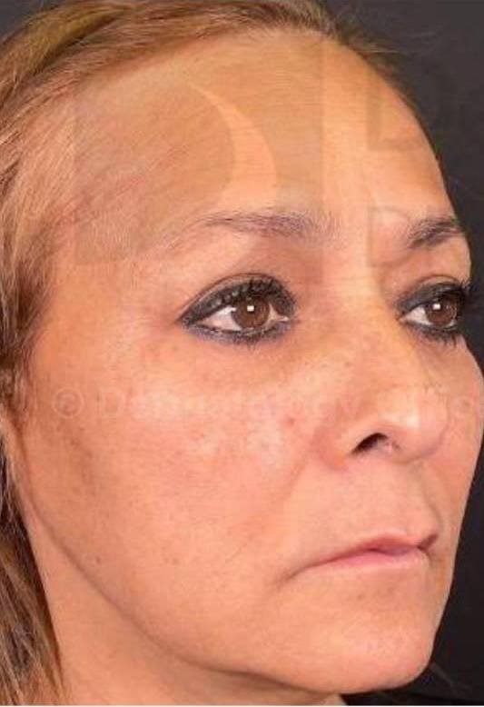 Juvederm  Case-18 Before