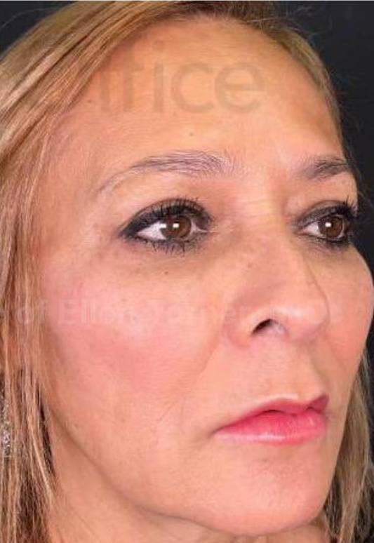 Juvederm  Case-18 After