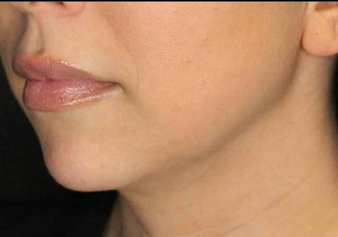 Juvederm  Case-21 Before