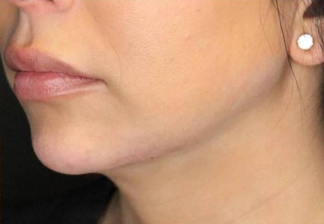 Juvederm  Case-21 After