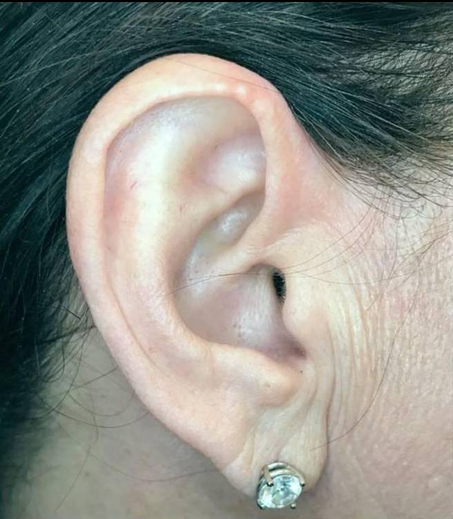 Juvederm  Case-23 Before