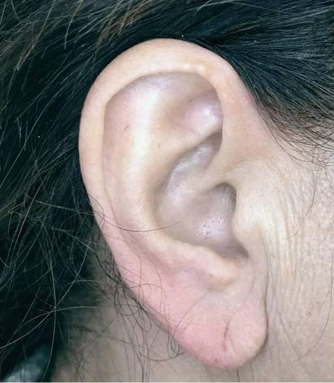 Juvederm  Case-23 After