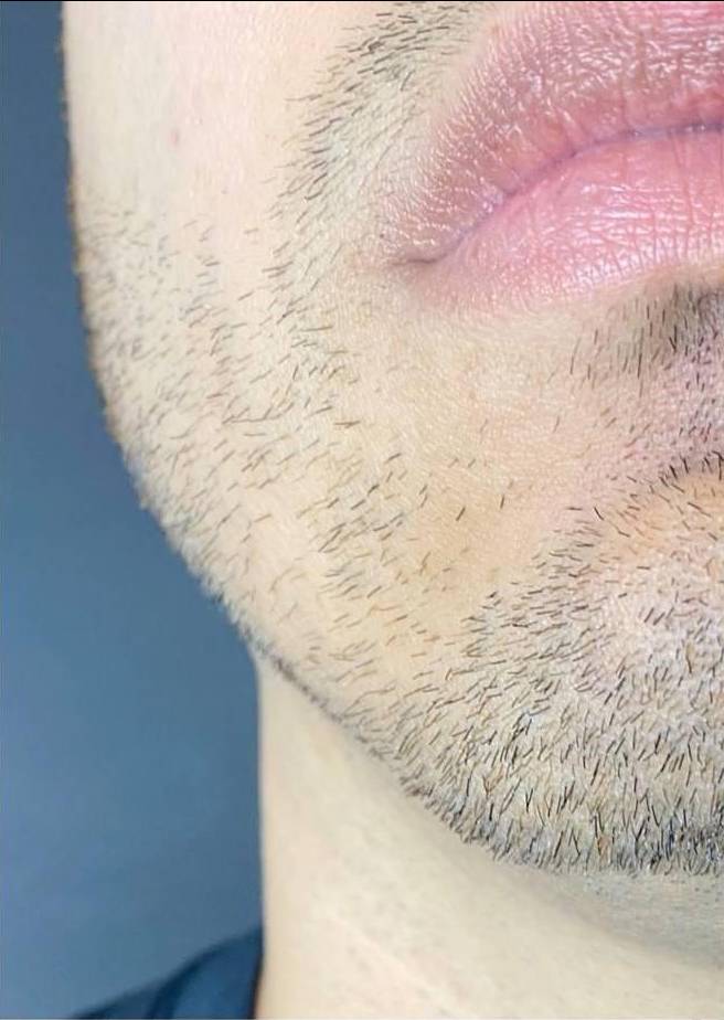 Juvederm  Case-24 Before