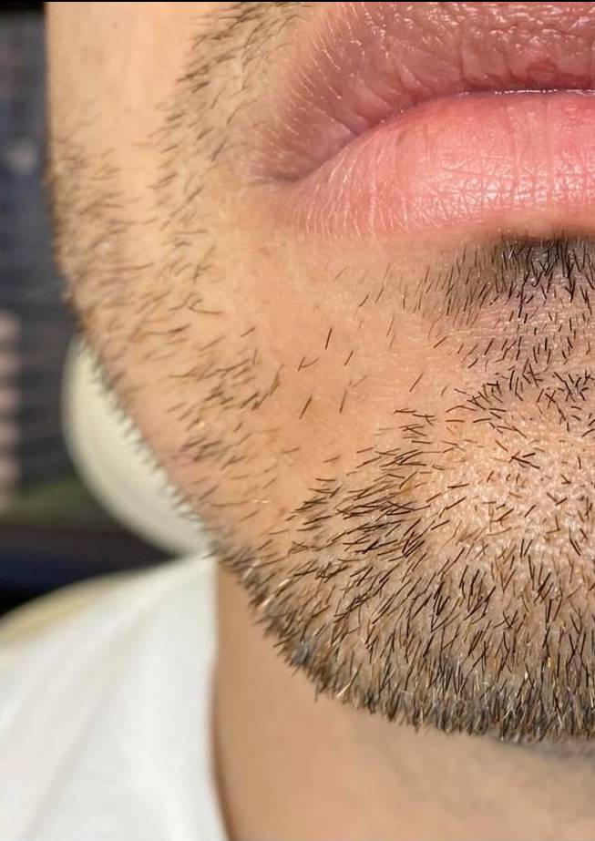 Juvederm  Case-24 After