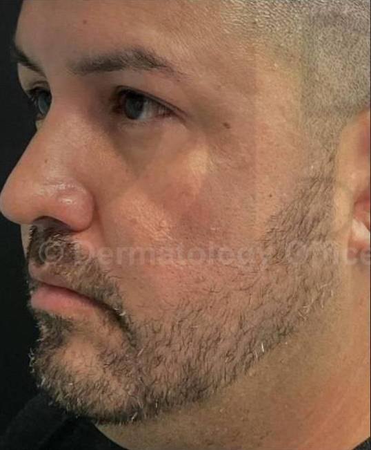 Juvederm  Case-28 Before