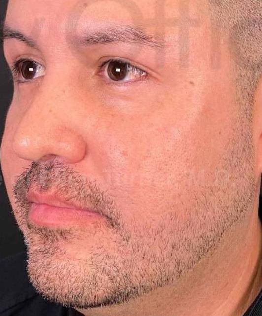 Juvederm  Case-28 After