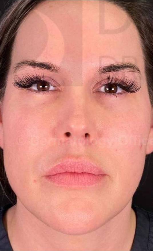 Juvederm  Case-36 Before