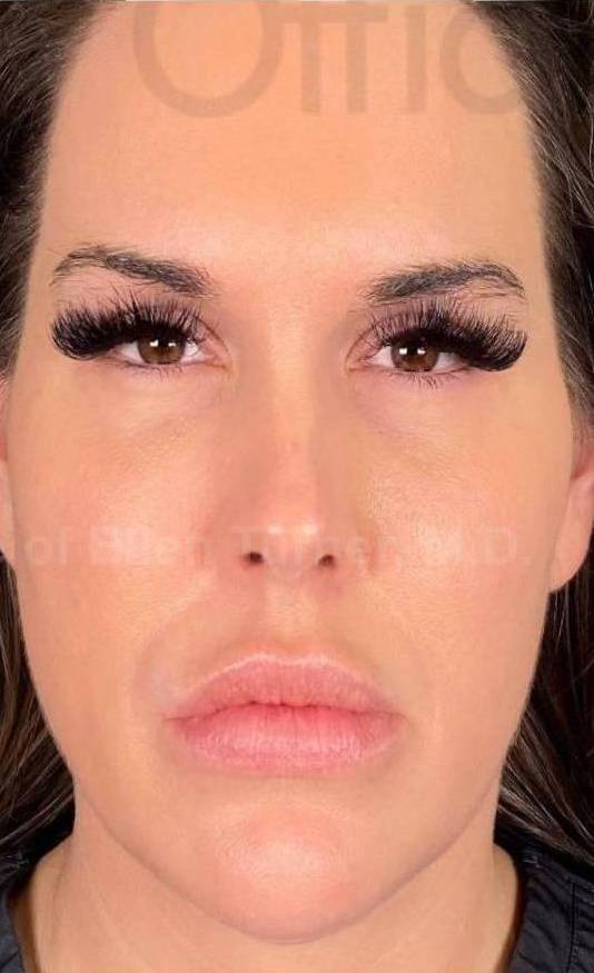 Juvederm  Case-36 After