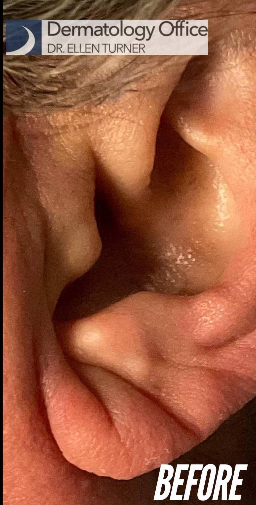 Juvederm  Case-40 Before