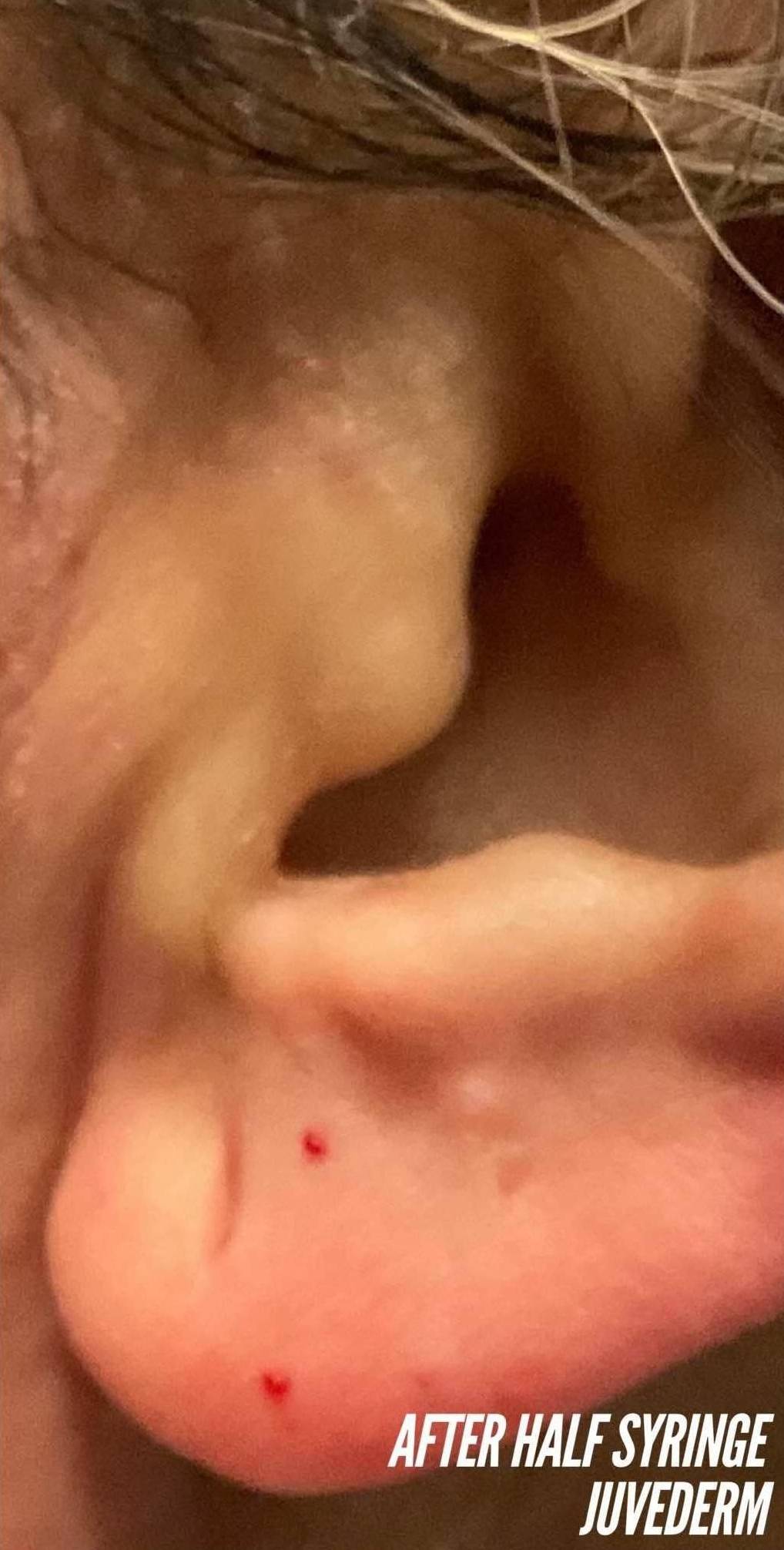 Juvederm  Case-40 After