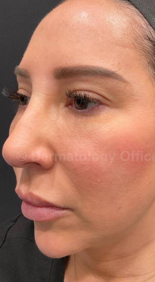 Juvederm  Case-41 Before