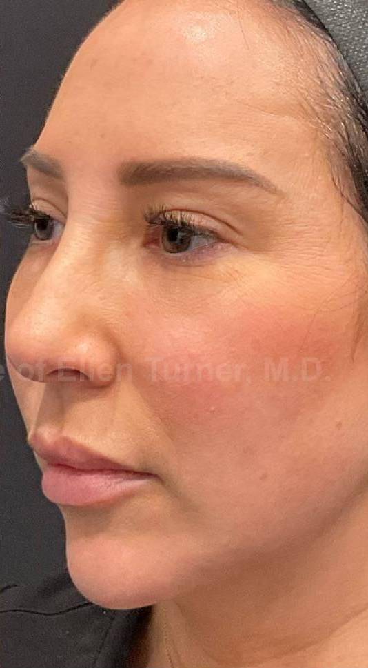 Juvederm  Case-41 After