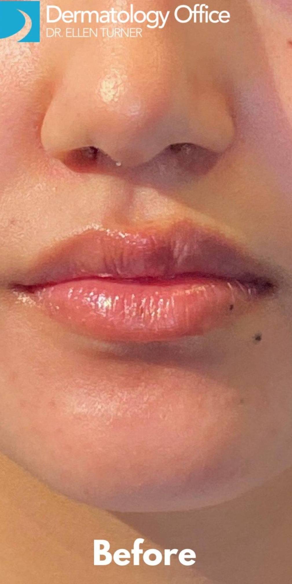 Juvederm (2 Syringes) Case-4 Before