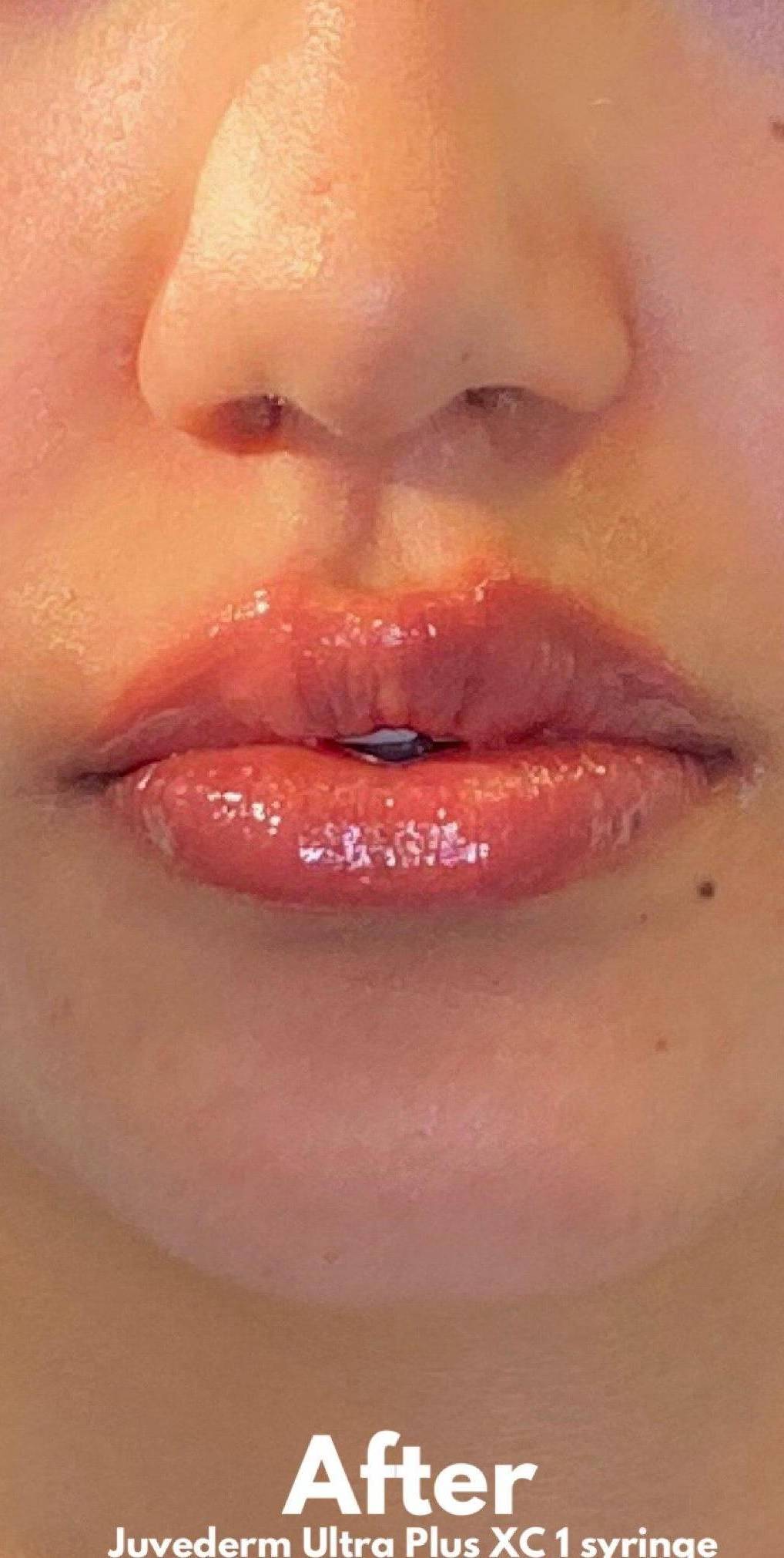 Juvederm (2 Syringes) Case-4 After