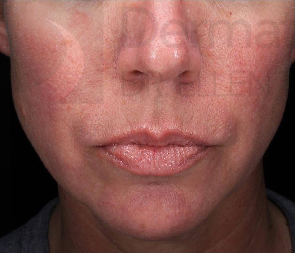 Juvederm (1 Syringe) Case-9 Before