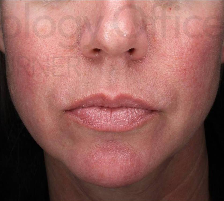 Juvederm (1 Syringe) Case-9 After