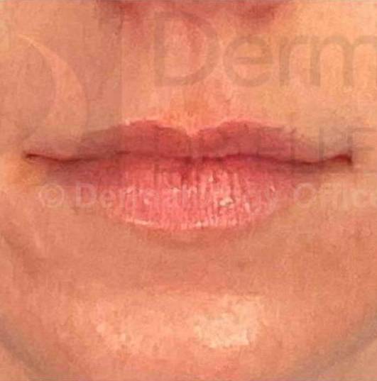 Juvederm (1 Syringe) Case-11 Before
